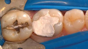 Fog tömés fogorvos